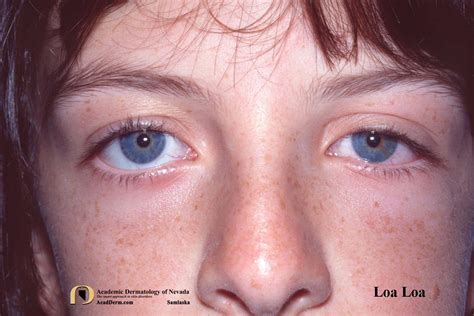 Loiasis: Loa Loa, Tropical Swelling... - Academic Dermatology of Nevada