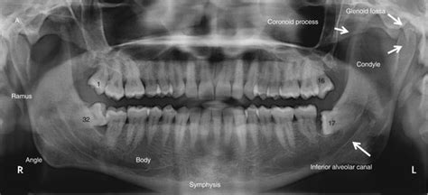 Maxilla and Mandible | Radiology Key