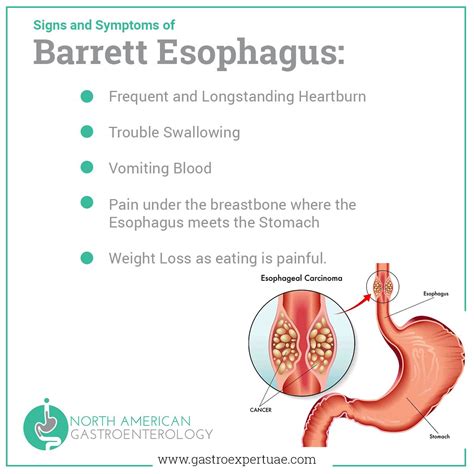 Barrett's Esophagus Cancer Symptoms