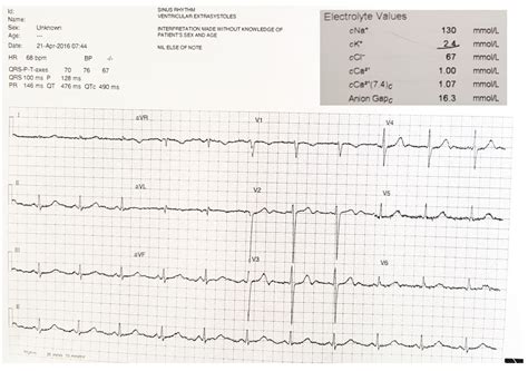 Hypokalemia | Deranged Physiology