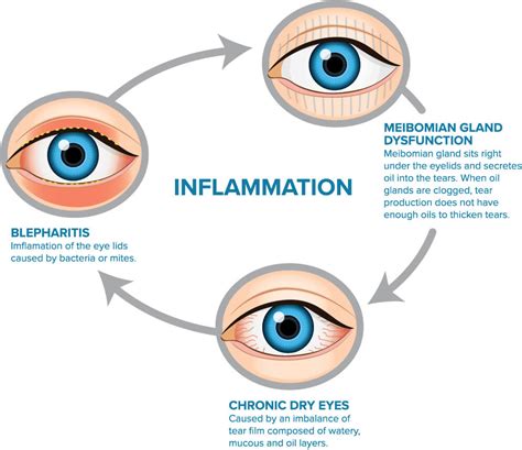 Zenoptiq- Managaing symptoms of MGD and Dry Eye