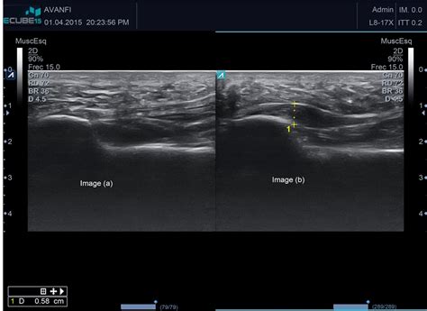 Ultrasound-Guided Plantar Fascia Release with Needle: A Novel Surgical ...