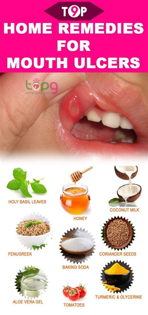 12 Amazing Home Remedies for Mouth Ulcers (With images) | Mouth ulcers ...