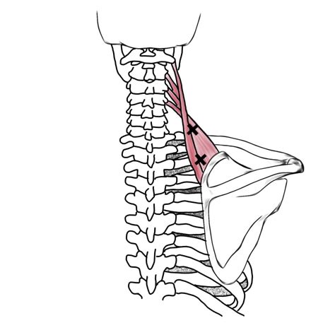 Trigger Points: Levator Scapula Trigger Points and Referral Patterns