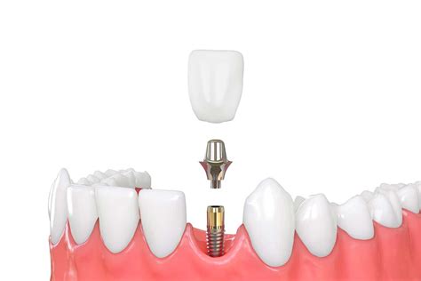 Dental Implant and Crown: Is This Combination Right for You?