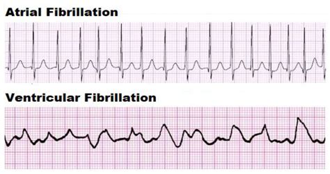 Ventricular Fibrillation Vs Atrial Fibrillation