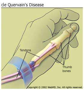 De quervain disease; Stenosing Tenosynovitis, De Quervain