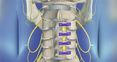 Comparison of Laminoplasty vs. Laminectomy