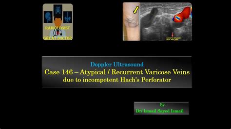 Ultrasound Case 146 - Atypical Varicose Veins due to Refluxive Hach ...