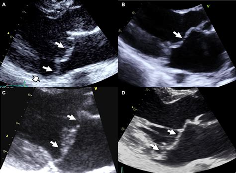 Frontiers | Genetics and pathophysiology of mitral valve prolapse