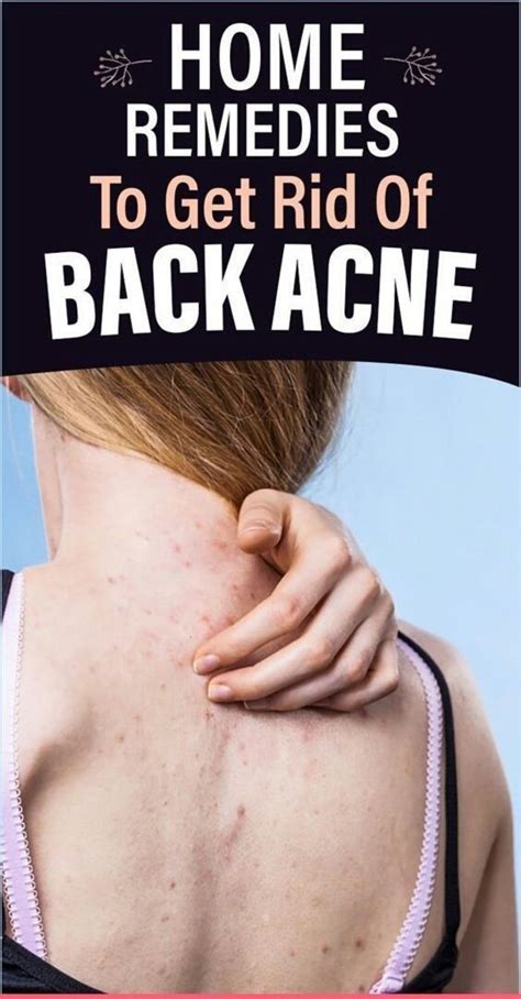 Back Acne Home Remedies | atelier-yuwa.ciao.jp