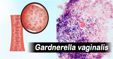 Habitat and Morphology of Gardnerella vaginalis