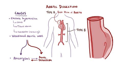 Aortic dissection: Video, Anatomy & Definition | Osmosis