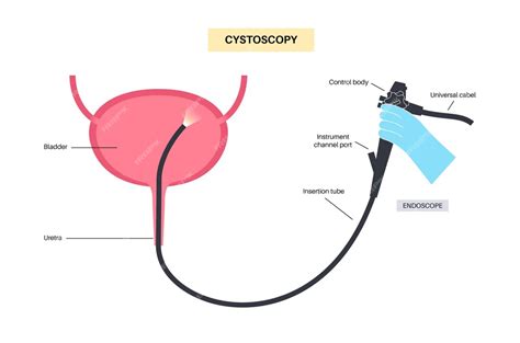 Premium Vector | Cystoscopy is a minimally invasive procedure ...