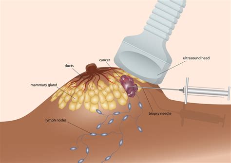 Biopsy | ACS