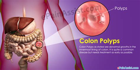 Colon Polyps: Symptoms, Types, Causes, Prevent & Pictures