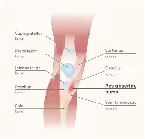 Pes anserine bursitis - Injurymap