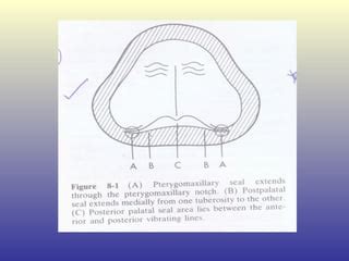 posterior palatal seal | PPT