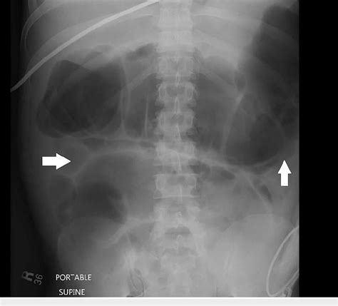 Figure 1 from Chronic Intestinal Pseudo-Obstruction in a Young Male ...