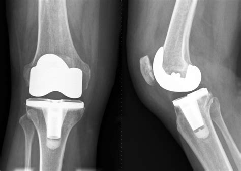 [DIAGRAM] Diagram Of Knee Replacement - MYDIAGRAM.ONLINE