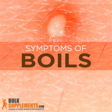 Boils: Symptoms, Causes and Treatment