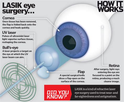 How does laser eye surgery work? | How It Works Magazine