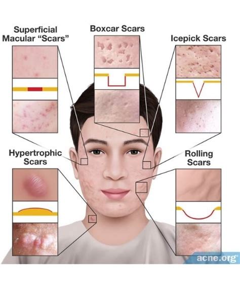 What Causes Acne Scars? - Acne Scars Treatment