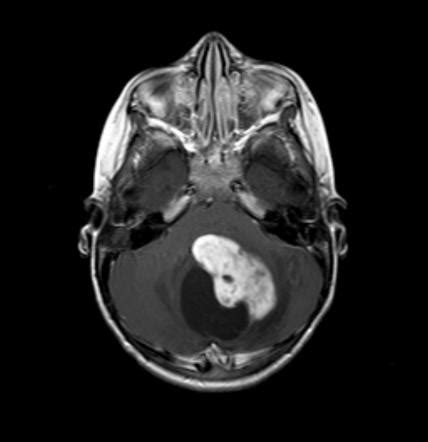 Pilocytic Astrocytoma - Oncology - Medbullets Step 2/3