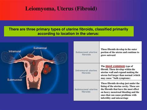 Myoma Uteri Presentation