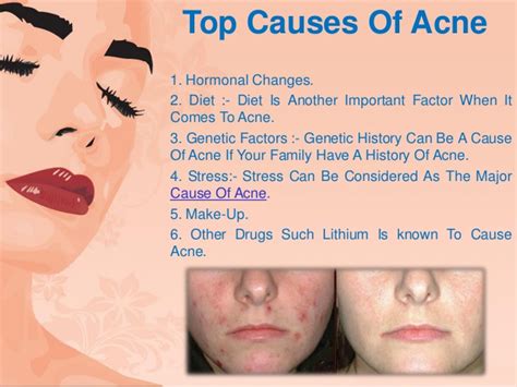 What Is Acne – A Brief Users Guide For Parents, Teens And The Rest Of ...