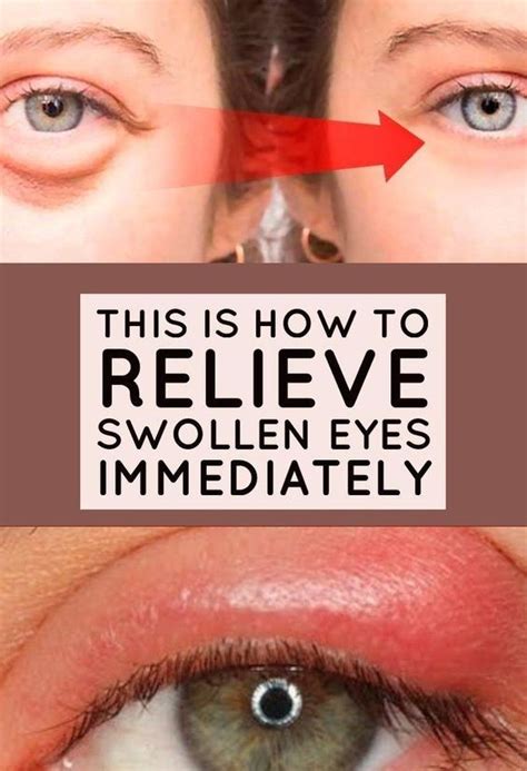 How To Get Rid Of Eye Pimple | Swollen eyes, Swollen eye remedies ...