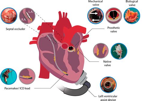 Frontiers | Native valve, prosthetic valve, and cardiac device-related ...