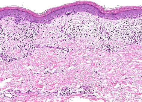 Mycosis Fungoides Histology