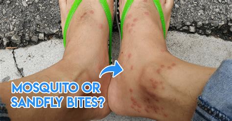 7 Insect Bites Singaporeans Have Gotten At Some Point & How To Identify ...