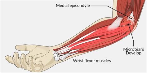 Sports injury conditions Golfer’s Elbow – The Body Rehab