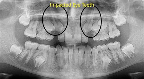 Impacted teeth