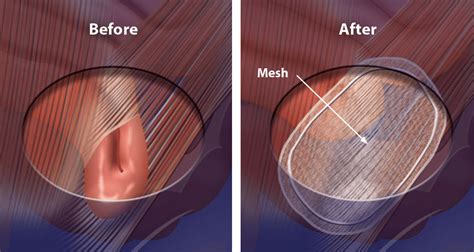 Hernia Surgery in Glasgow - Scottish Hernia Centre