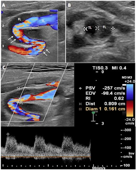 Preoperative Carotid Duplex Ultrasound. (A) There is turbulence (white ...