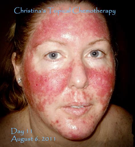 My Journey Through Topical Chemotherapy - Fluorouracil 5% Cream and ...