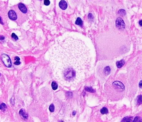 neuropathology blog: Xanthic cell in a pleomorphic xanthoastrocytoma