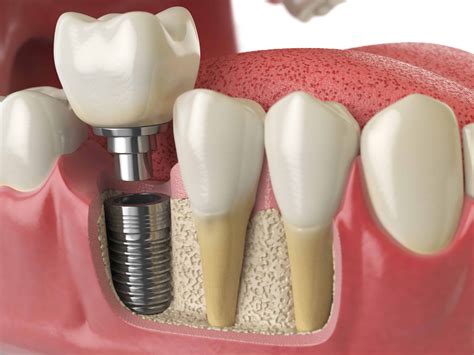 Dental Implants - Borough Dental Care Call Now on 0207 407 3883