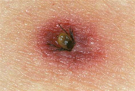 Tick bites on Humans – Images, Symptoms, Causes, Treatment - HubPages