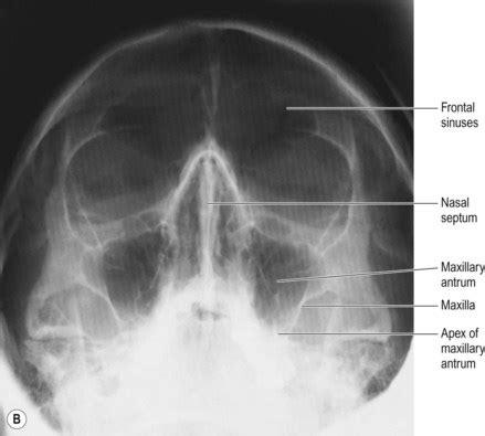 Paranasal Sinuses X Ray