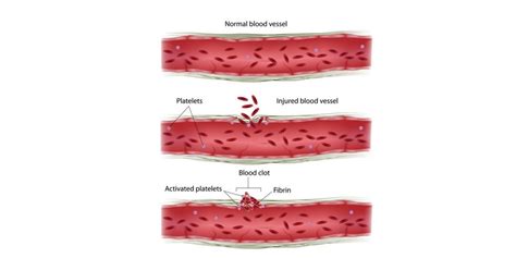 Parahemophilia (Factor V Deficiency) Nursing Management - RNpedia