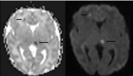 Diffusion weighted images. Small areas of diffusion restriction seen in ...