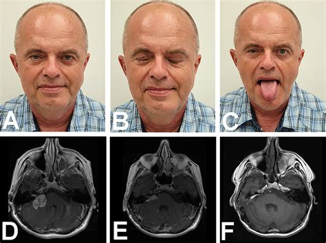 Frontiers | Surgery After Surgery for Vestibular Schwannoma: A Case Series