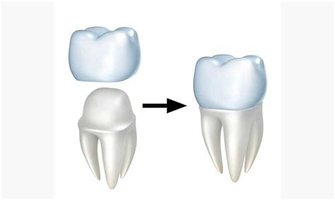 Study finds 3D Printing is Superior for Dental Crowns - 3D Printing