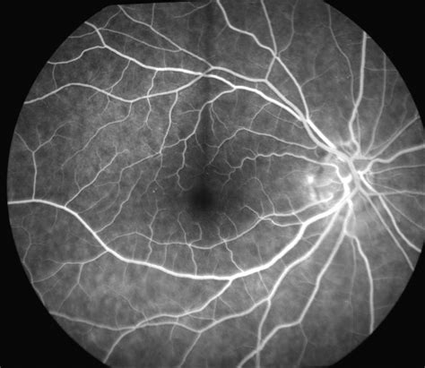 Macular Edema Fluorescein Angiography