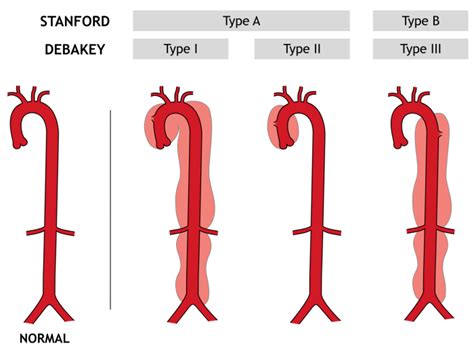 Thoracic Aortic Aneurysm Classification