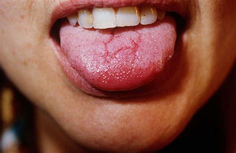 Geographic Tongue: 10 Causes of Geographic Tongue